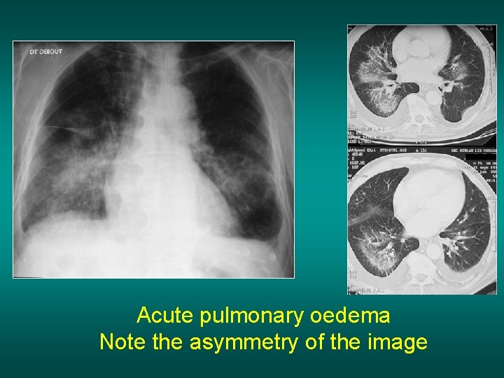 Acute pulmonary oedema Note the asymmetry of the image 