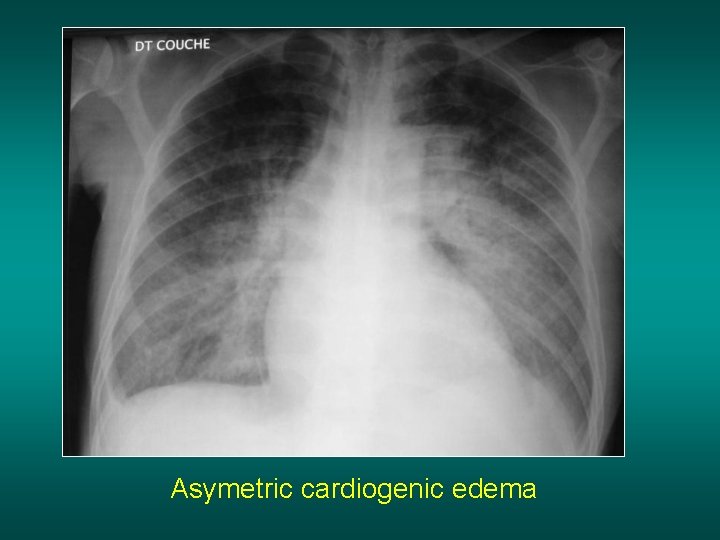 Asymetric cardiogenic edema 