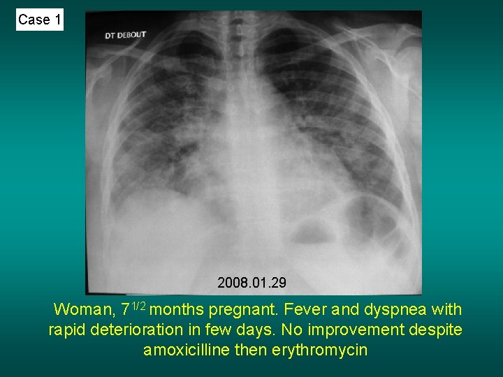 Case 1 2008. 01. 29 Woman, 71/2 months pregnant. Fever and dyspnea with rapid
