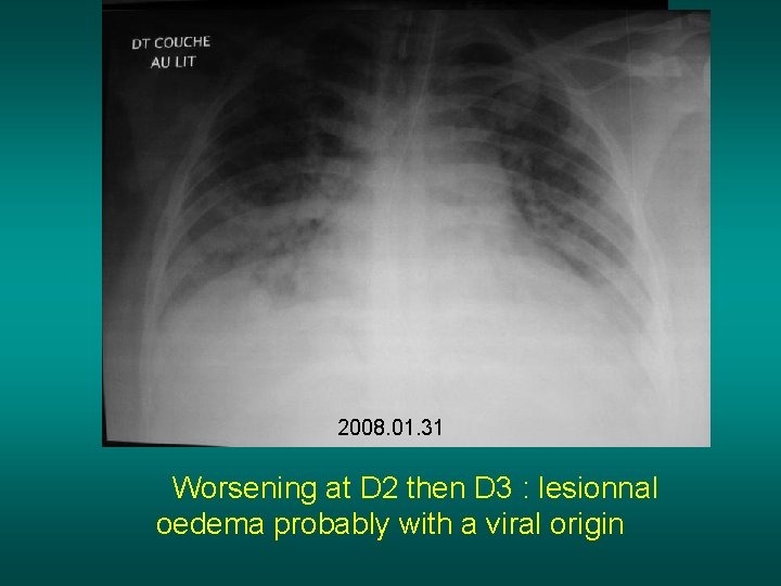 2008. 01. 30 2008. 01. 31 Worsening at D 2 then D 3 :