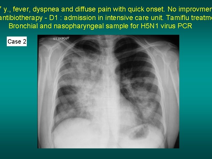 7 y. , fever, dyspnea and diffuse pain with quick onset. No improvmen antibiotherapy