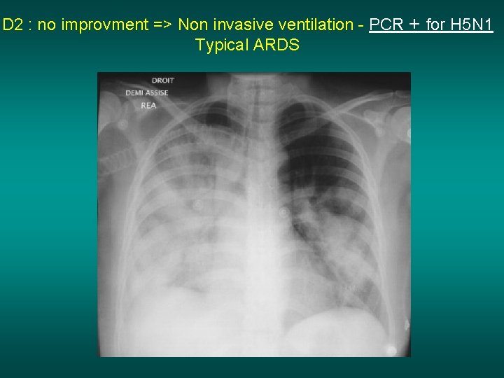 D 2 : no improvment => Non invasive ventilation - PCR + for H