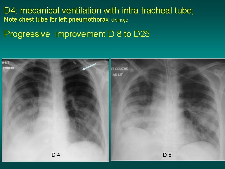 D 4: mecanical ventilation with intra tracheal tube; Note chest tube for left pneumothorax