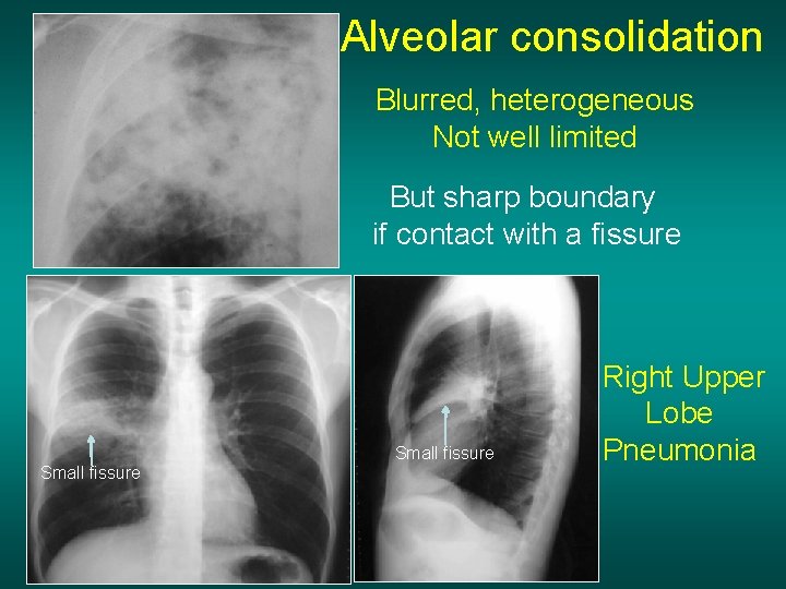 Alveolar consolidation Blurred, heterogeneous Not well limited But sharp boundary if contact with a