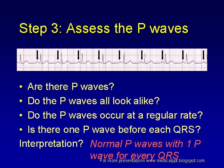 Step 3: Assess the P waves • Are there P waves? • Do the Step 3: Assess the P waves • Are there P waves? • Do the