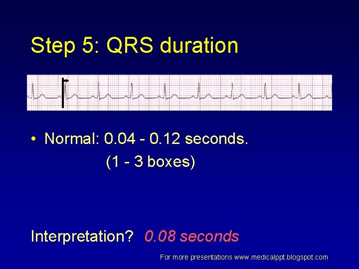 Step 5: QRS duration • Normal: 0. 04 - 0. 12 seconds. (1 - Step 5: QRS duration • Normal: 0. 04 - 0. 12 seconds. (1 -
