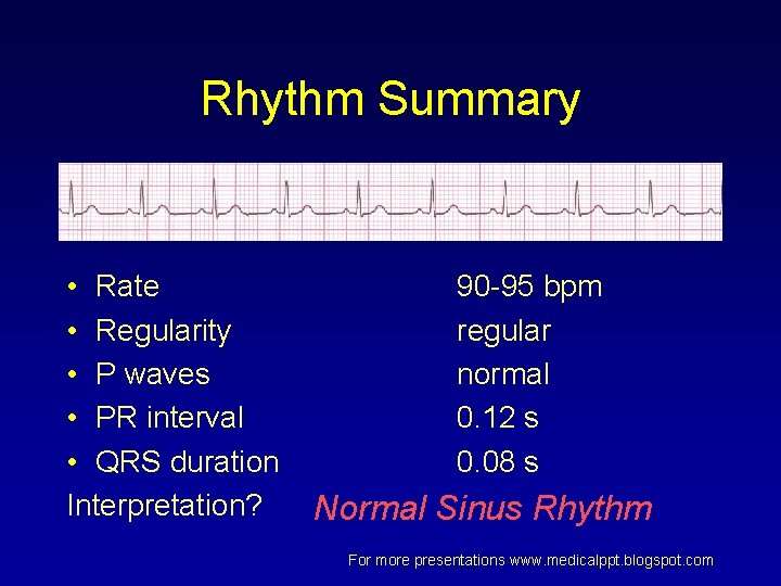 Rhythm Summary • Rate • Regularity • P waves • PR interval • QRS Rhythm Summary • Rate • Regularity • P waves • PR interval • QRS