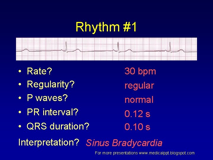 Rhythm #1 • • • Rate? Regularity? P waves? PR interval? QRS duration? 30 Rhythm #1 • • • Rate? Regularity? P waves? PR interval? QRS duration? 30