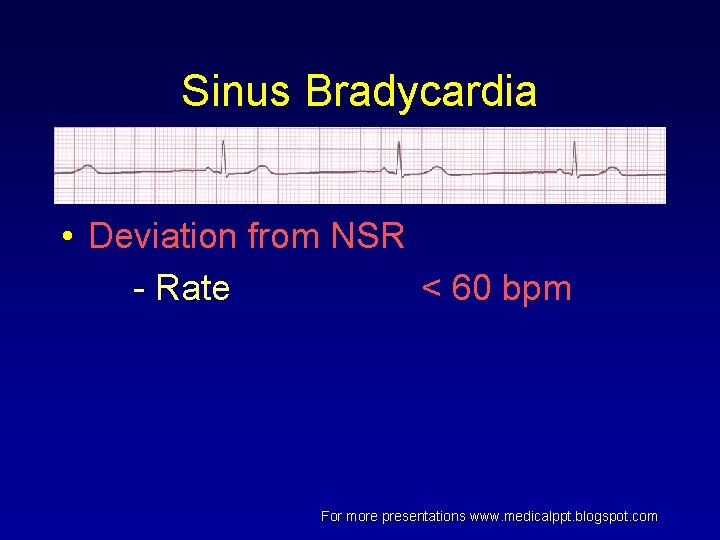 Sinus Bradycardia • Deviation from NSR - Rate < 60 bpm For more presentations Sinus Bradycardia • Deviation from NSR - Rate < 60 bpm For more presentations