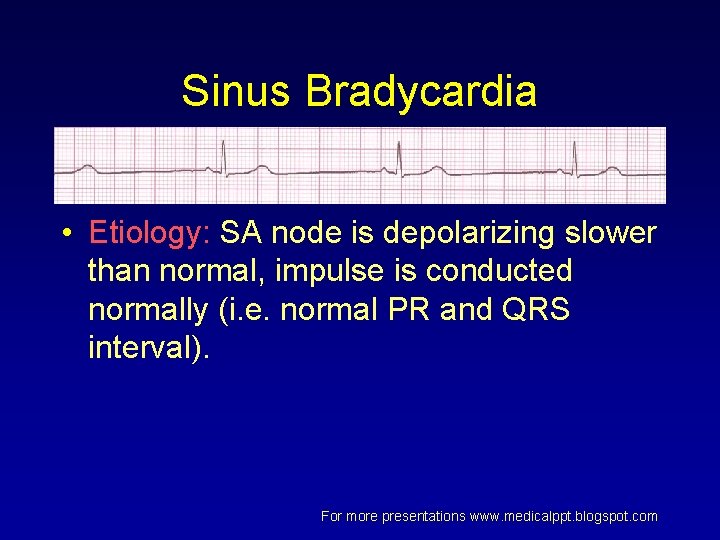 Sinus Bradycardia • Etiology: SA node is depolarizing slower than normal, impulse is conducted Sinus Bradycardia • Etiology: SA node is depolarizing slower than normal, impulse is conducted
