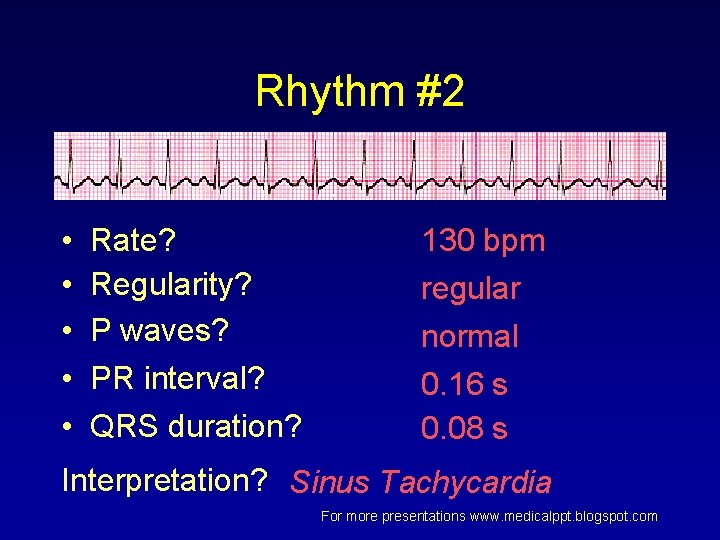 Rhythm #2 • • • Rate? Regularity? P waves? PR interval? QRS duration? 130 Rhythm #2 • • • Rate? Regularity? P waves? PR interval? QRS duration? 130