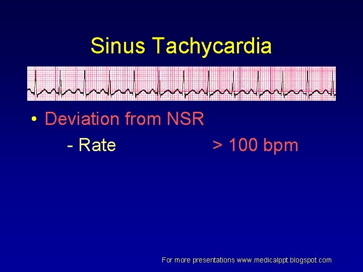 Sinus Tachycardia • Deviation from NSR - Rate > 100 bpm For more presentations Sinus Tachycardia • Deviation from NSR - Rate > 100 bpm For more presentations