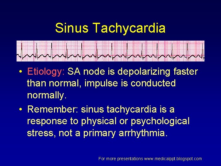 Sinus Tachycardia • Etiology: SA node is depolarizing faster than normal, impulse is conducted Sinus Tachycardia • Etiology: SA node is depolarizing faster than normal, impulse is conducted