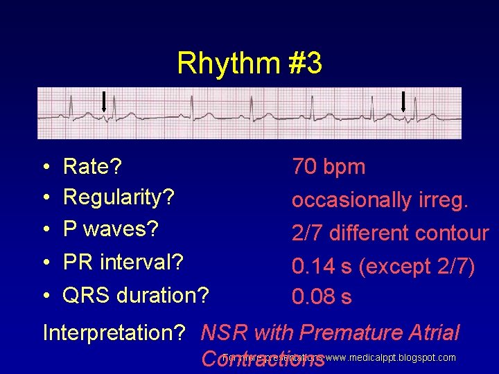 Rhythm #3 • • • Rate? Regularity? P waves? PR interval? QRS duration? 70 Rhythm #3 • • • Rate? Regularity? P waves? PR interval? QRS duration? 70