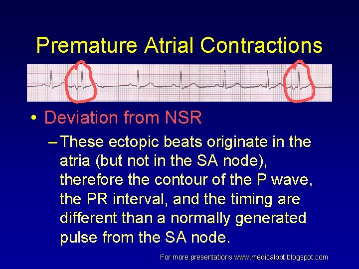 Premature Atrial Contractions • Deviation from NSR – These ectopic beats originate in the Premature Atrial Contractions • Deviation from NSR – These ectopic beats originate in the