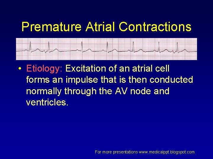 Premature Atrial Contractions • Etiology: Excitation of an atrial cell forms an impulse that Premature Atrial Contractions • Etiology: Excitation of an atrial cell forms an impulse that