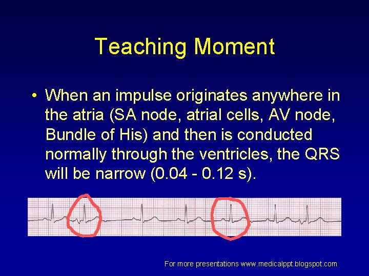 Teaching Moment • When an impulse originates anywhere in the atria (SA node, atrial Teaching Moment • When an impulse originates anywhere in the atria (SA node, atrial