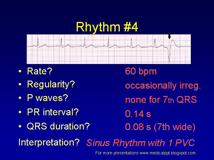 Rhythm #4 • • • Rate? Regularity? P waves? PR interval? QRS duration? 60 Rhythm #4 • • • Rate? Regularity? P waves? PR interval? QRS duration? 60