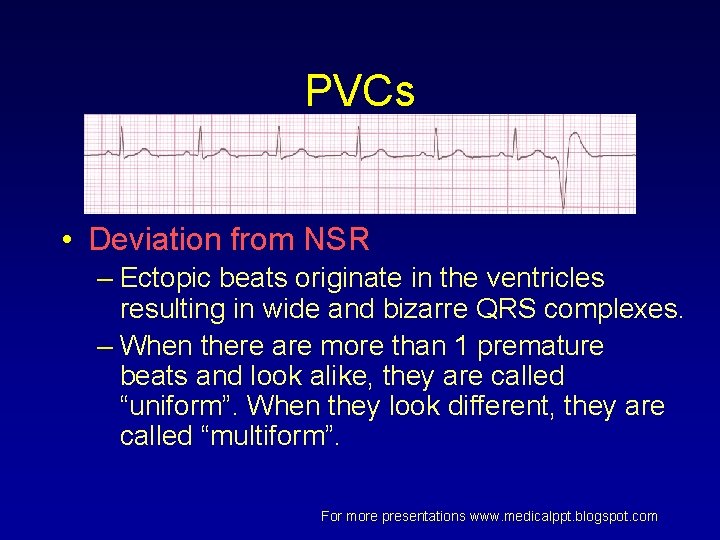 PVCs • Deviation from NSR – Ectopic beats originate in the ventricles resulting in PVCs • Deviation from NSR – Ectopic beats originate in the ventricles resulting in