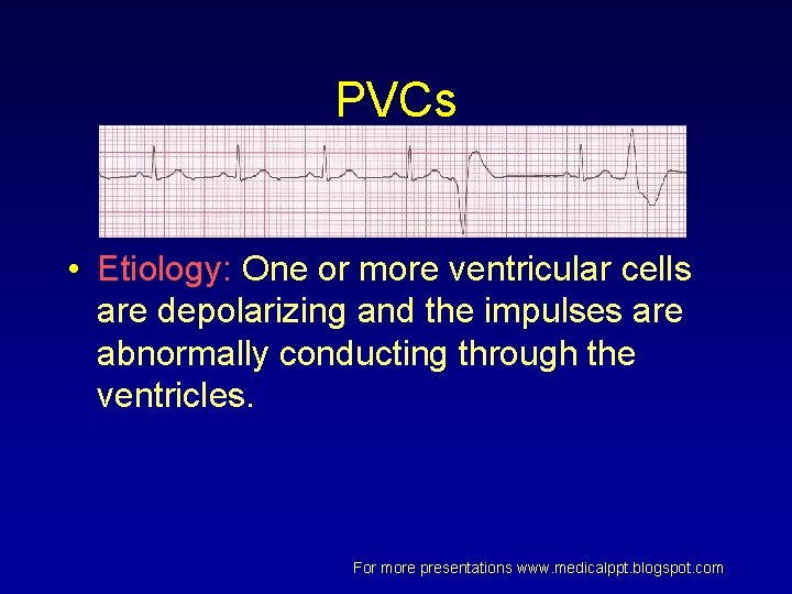 PVCs • Etiology: One or more ventricular cells are depolarizing and the impulses are PVCs • Etiology: One or more ventricular cells are depolarizing and the impulses are