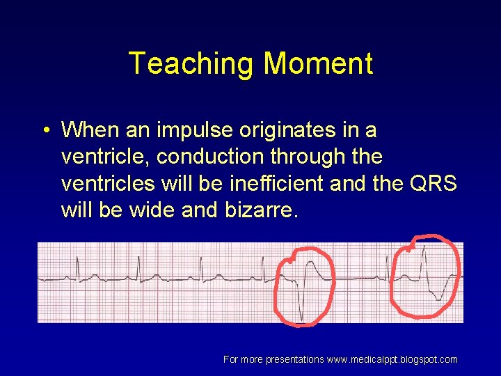 Teaching Moment • When an impulse originates in a ventricle, conduction through the ventricles Teaching Moment • When an impulse originates in a ventricle, conduction through the ventricles