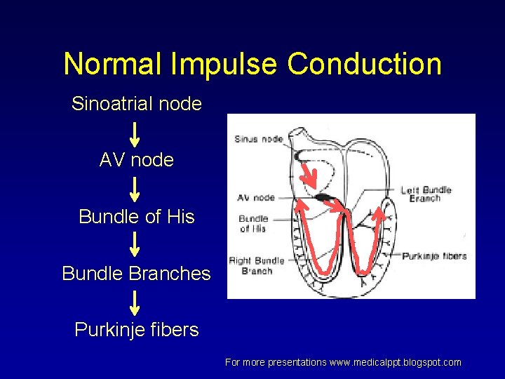 Normal Impulse Conduction Sinoatrial node AV node Bundle of His Bundle Branches Purkinje fibers Normal Impulse Conduction Sinoatrial node AV node Bundle of His Bundle Branches Purkinje fibers
