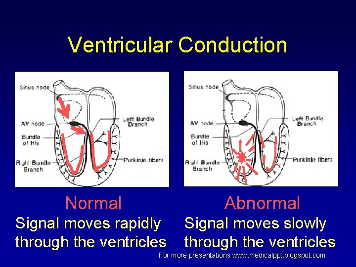 Ventricular Conduction Normal Abnormal Signal moves rapidly through the ventricles Signal moves slowly through Ventricular Conduction Normal Abnormal Signal moves rapidly through the ventricles Signal moves slowly through