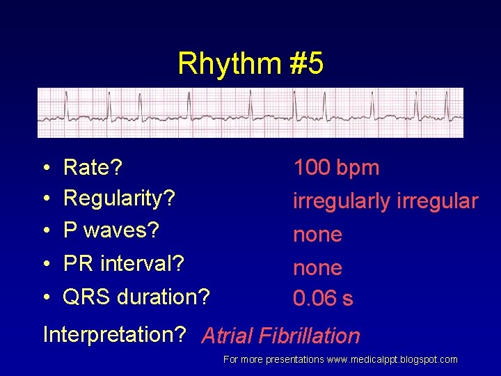 Rhythm #5 • • • Rate? Regularity? P waves? PR interval? QRS duration? 100 Rhythm #5 • • • Rate? Regularity? P waves? PR interval? QRS duration? 100