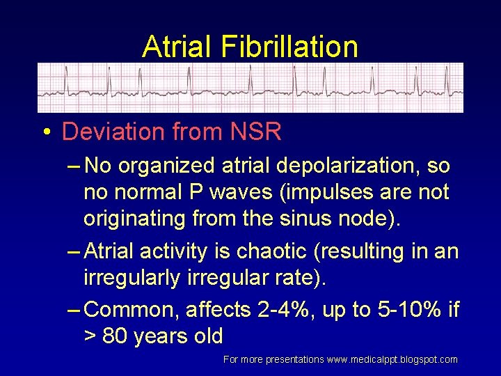 Atrial Fibrillation • Deviation from NSR – No organized atrial depolarization, so no normal Atrial Fibrillation • Deviation from NSR – No organized atrial depolarization, so no normal
