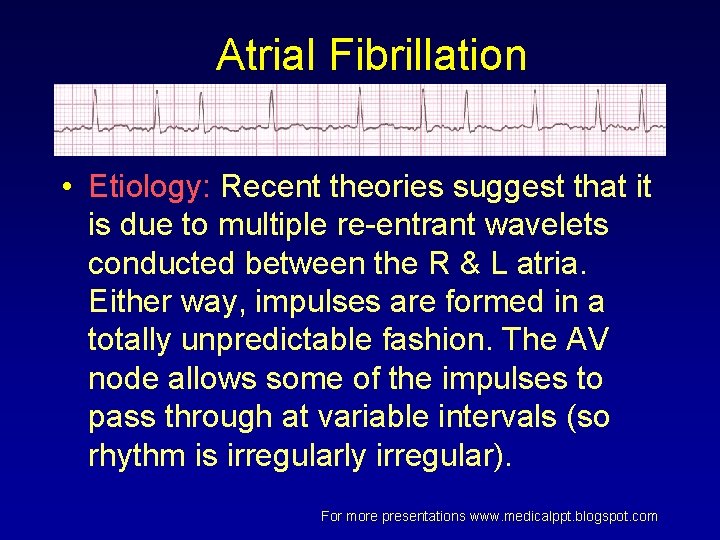 Atrial Fibrillation • Etiology: Recent theories suggest that it is due to multiple re-entrant Atrial Fibrillation • Etiology: Recent theories suggest that it is due to multiple re-entrant