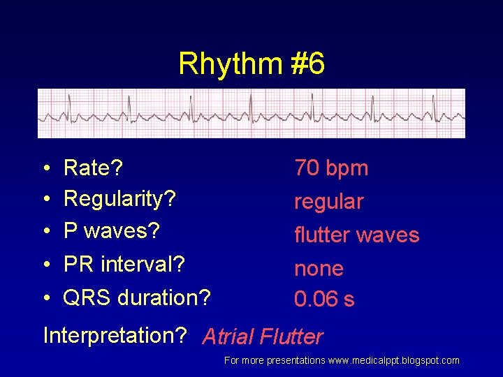 Rhythm #6 • • • Rate? Regularity? P waves? PR interval? QRS duration? 70 Rhythm #6 • • • Rate? Regularity? P waves? PR interval? QRS duration? 70