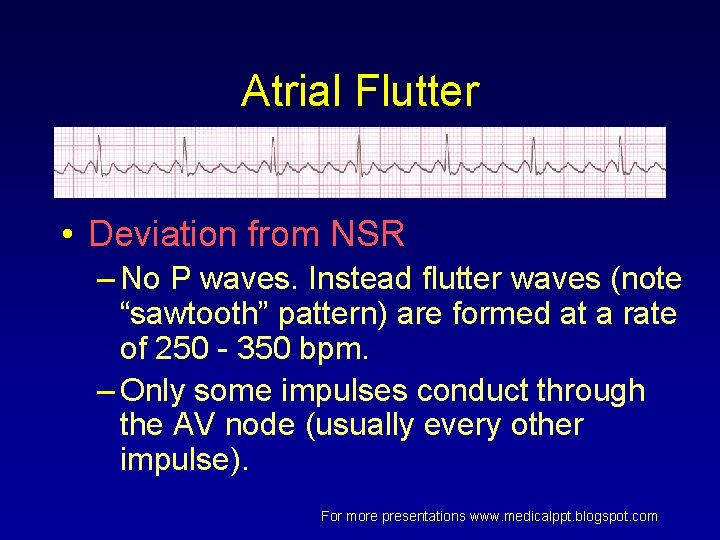 Atrial Flutter • Deviation from NSR – No P waves. Instead flutter waves (note Atrial Flutter • Deviation from NSR – No P waves. Instead flutter waves (note