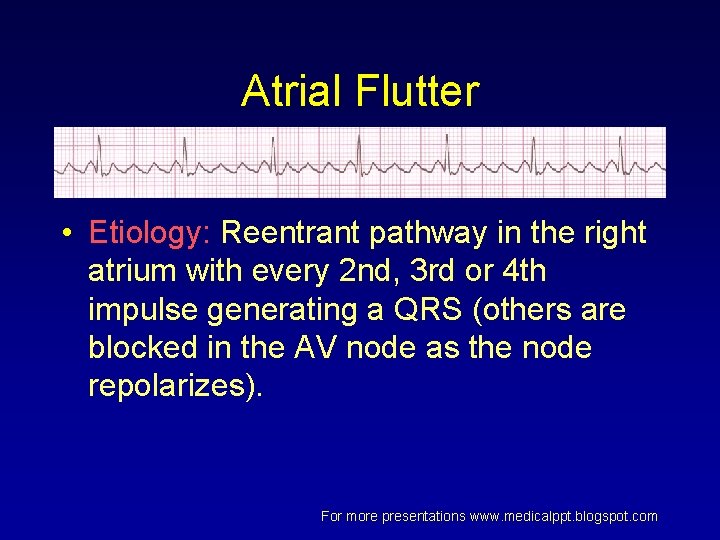 Atrial Flutter • Etiology: Reentrant pathway in the right atrium with every 2 nd, Atrial Flutter • Etiology: Reentrant pathway in the right atrium with every 2 nd,