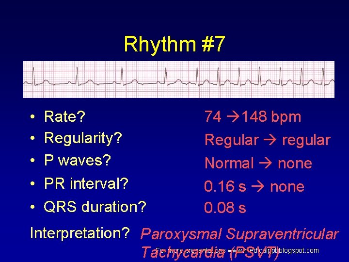 Rhythm #7 • • • Rate? Regularity? P waves? PR interval? QRS duration? 74 Rhythm #7 • • • Rate? Regularity? P waves? PR interval? QRS duration? 74