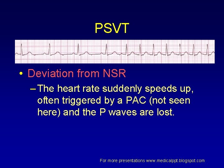 PSVT • Deviation from NSR – The heart rate suddenly speeds up, often triggered PSVT • Deviation from NSR – The heart rate suddenly speeds up, often triggered