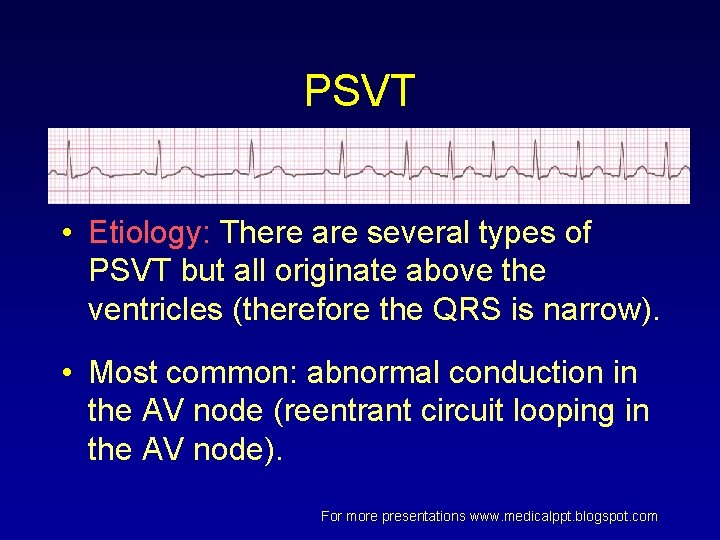 PSVT • Etiology: There are several types of PSVT but all originate above the PSVT • Etiology: There are several types of PSVT but all originate above the
