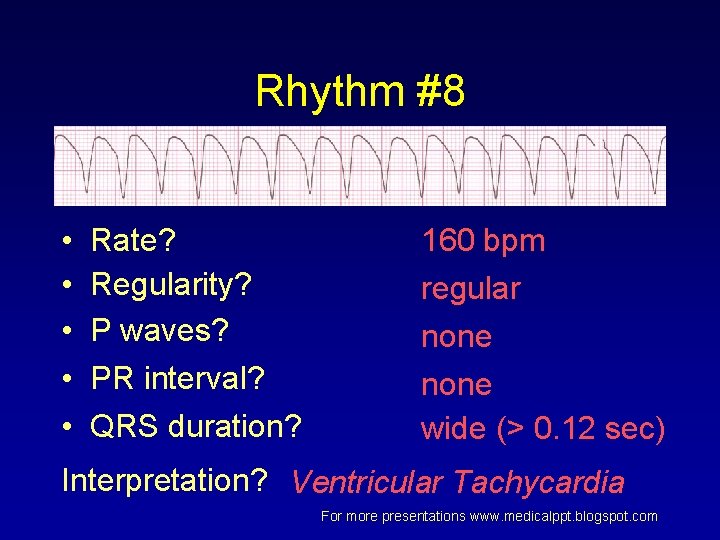 Rhythm #8 • • • Rate? Regularity? P waves? PR interval? QRS duration? 160 Rhythm #8 • • • Rate? Regularity? P waves? PR interval? QRS duration? 160