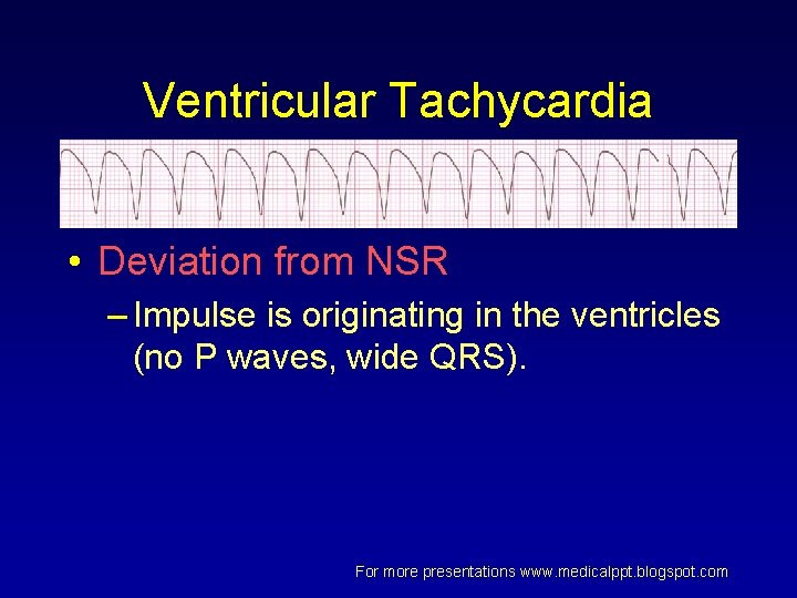 Ventricular Tachycardia • Deviation from NSR – Impulse is originating in the ventricles (no Ventricular Tachycardia • Deviation from NSR – Impulse is originating in the ventricles (no