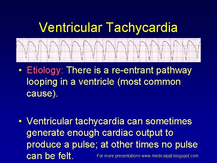 Ventricular Tachycardia • Etiology: There is a re-entrant pathway looping in a ventricle (most Ventricular Tachycardia • Etiology: There is a re-entrant pathway looping in a ventricle (most