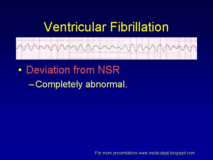 Ventricular Fibrillation • Deviation from NSR – Completely abnormal. For more presentations www. medicalppt. Ventricular Fibrillation • Deviation from NSR – Completely abnormal. For more presentations www. medicalppt.