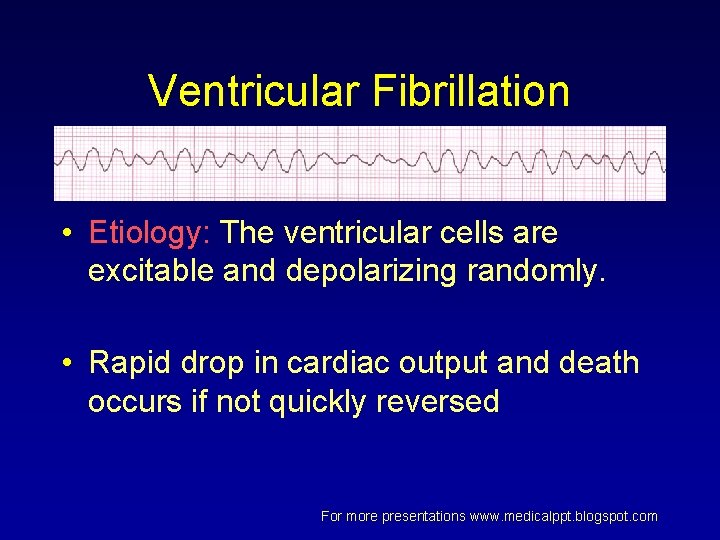 Ventricular Fibrillation • Etiology: The ventricular cells are excitable and depolarizing randomly. • Rapid Ventricular Fibrillation • Etiology: The ventricular cells are excitable and depolarizing randomly. • Rapid