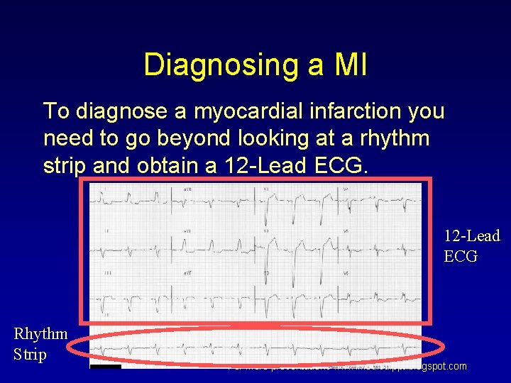 Diagnosing a MI To diagnose a myocardial infarction you need to go beyond looking Diagnosing a MI To diagnose a myocardial infarction you need to go beyond looking
