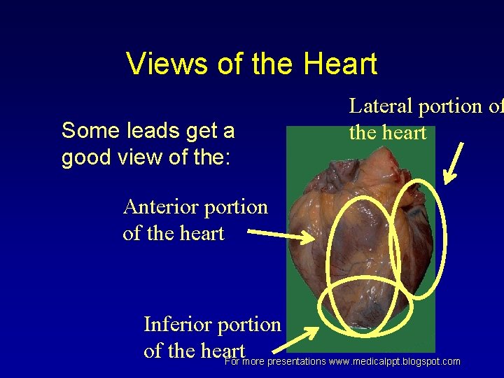 Views of the Heart Some leads get a good view of the: Lateral portion Views of the Heart Some leads get a good view of the: Lateral portion