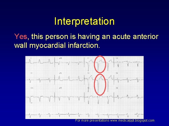 Interpretation Yes, this person is having an acute anterior wall myocardial infarction. For more Interpretation Yes, this person is having an acute anterior wall myocardial infarction. For more