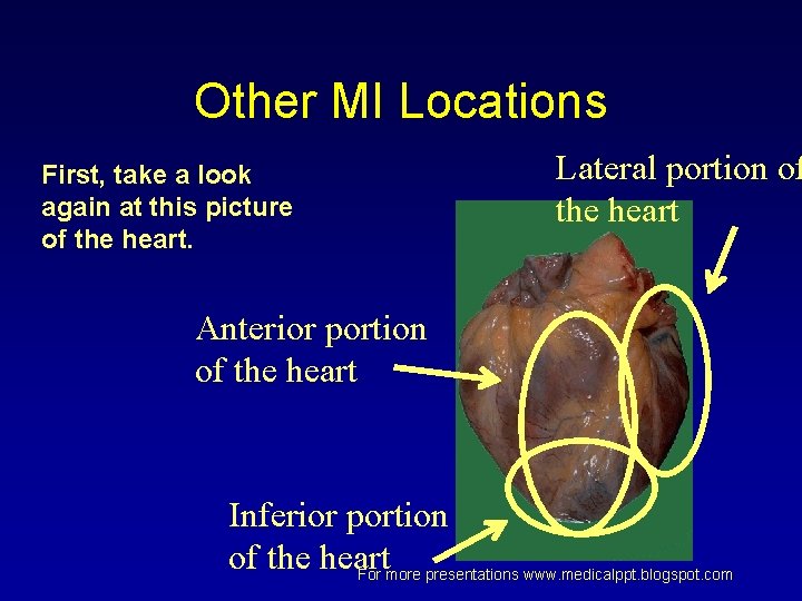 Other MI Locations First, take a look again at this picture of the heart. Other MI Locations First, take a look again at this picture of the heart.