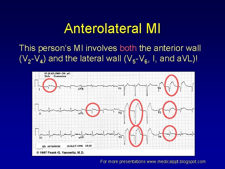 Anterolateral MI This person’s MI involves both the anterior wall (V 2 -V 4) Anterolateral MI This person’s MI involves both the anterior wall (V 2 -V 4)