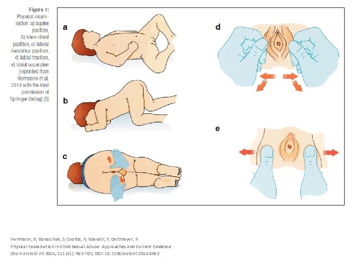 Herrmann, B; Banaschak, S; Csorba, R; Navratil, F; Dettmeyer, R Physical Examination in Child