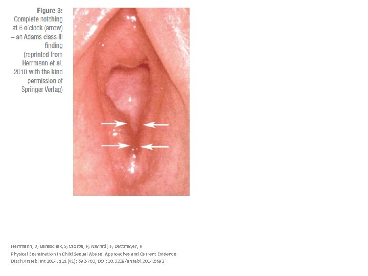 Herrmann, B; Banaschak, S; Csorba, R; Navratil, F; Dettmeyer, R Physical Examination in Child