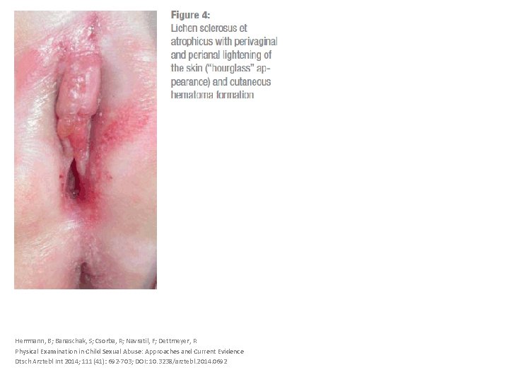 Herrmann, B; Banaschak, S; Csorba, R; Navratil, F; Dettmeyer, R Physical Examination in Child