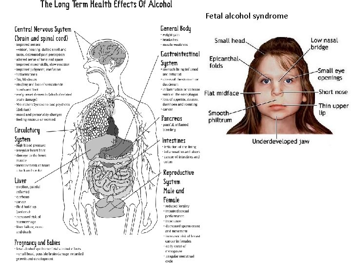 Fetal alcohol syndrome 